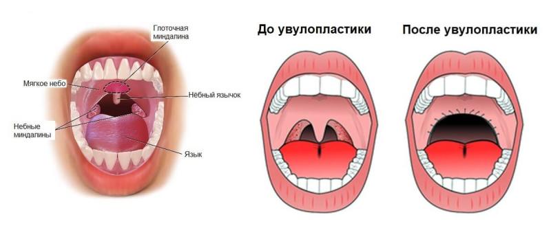 Увулит - симптомы, причины, лечение, диагностика заболевания