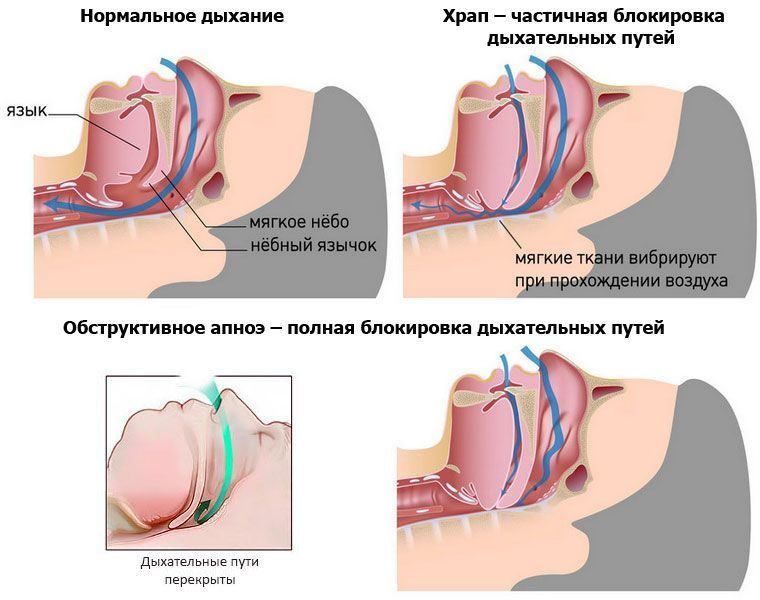 Болит небо сверху почему воспалилось Люмидент