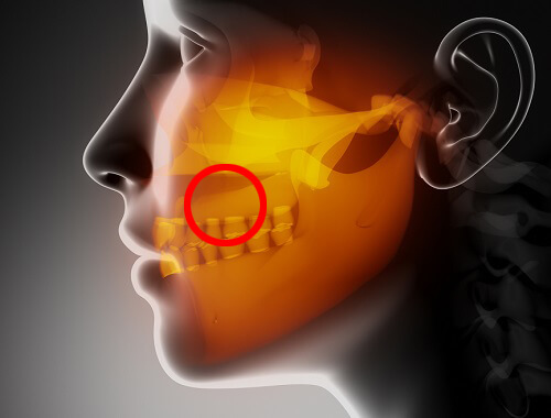 Virus-associated pharynx tumors in a 16 ...